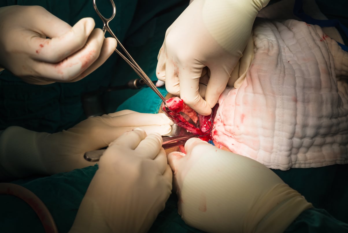 ligation appendix for appendectomy